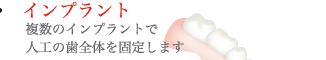 インプラント：複数のインプラントで人工の歯全体を固定します