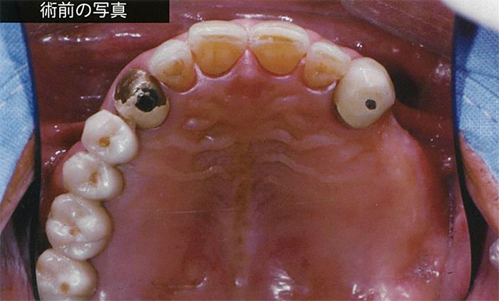 上顎部分入れ歯を使用していた場合