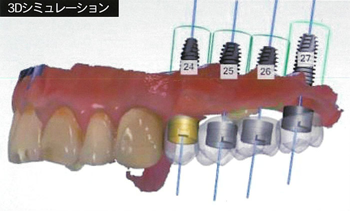 上顎部分入れ歯を使用していた場合