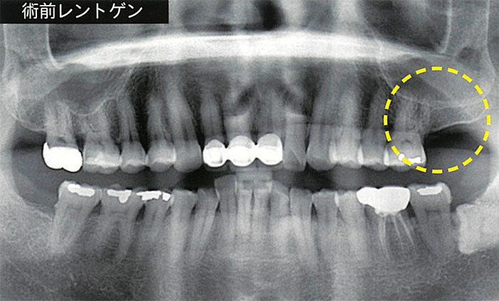 上顎臼歯部上顎洞底膜拳上術でインプラント施術