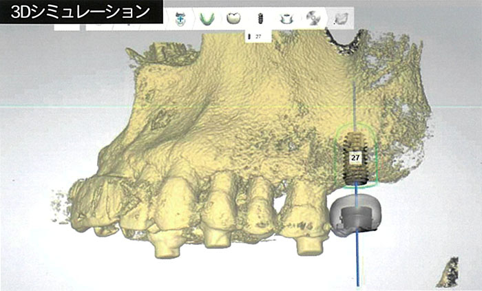 上顎臼歯部上顎洞底膜拳上術でインプラント施術