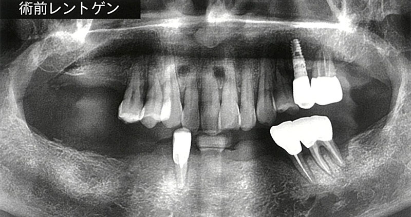 抜歯即日インプラント埋入後仮歯装着
