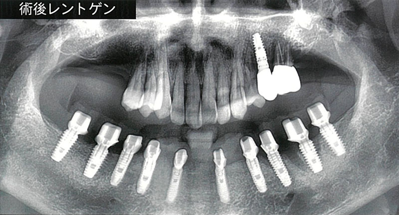 抜歯即日インプラント埋入後仮歯装着