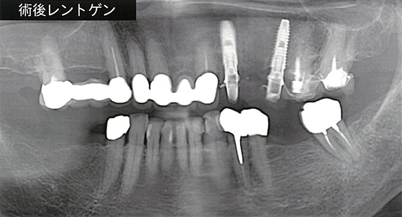 歯肉を切開せずに骨移植とインプラント埋入を同時に施術