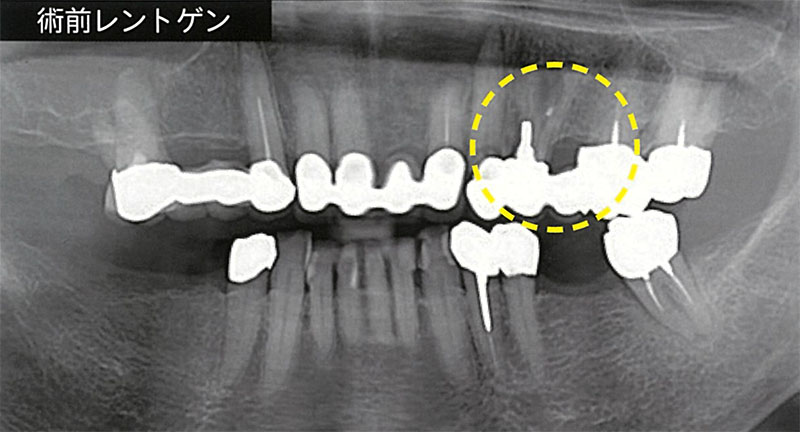歯肉を切開せずに骨移植とインプラント埋入を同時に施術