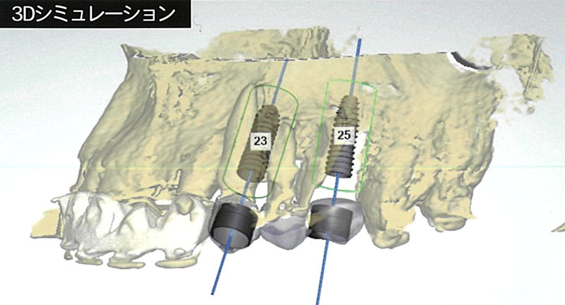 歯肉を切開せずに骨移植とインプラント埋入を同時に施術