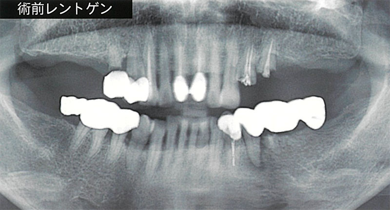 部分入れ歯を使用していた場合