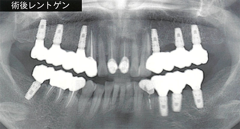 部分入れ歯を使用していた場合