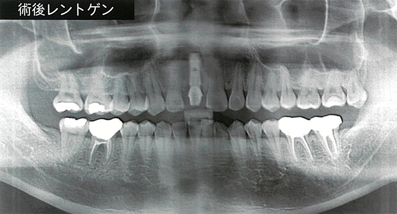 前歯欠損状態でインプラント施術後即日仮歯装着
