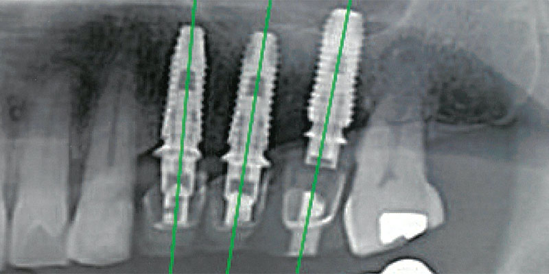 インプラント埋入の正確性の向上を目指す