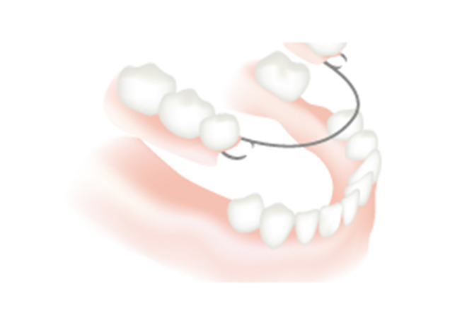 部分入れ歯