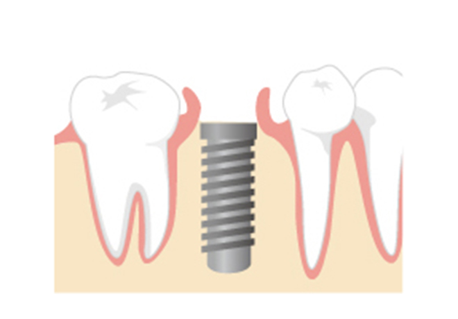 インプラント埋入手術